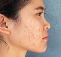 Retin-A for Acne Scars and Dark Spots: What Dermatology Research Says